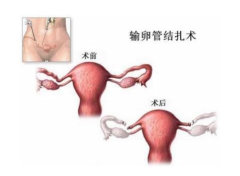 男性不育