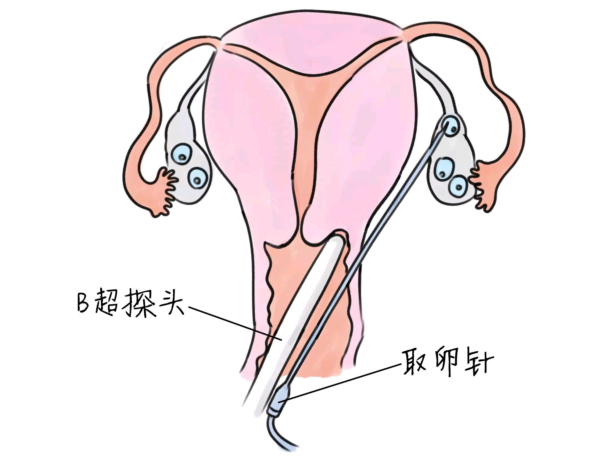 卵巢早衰