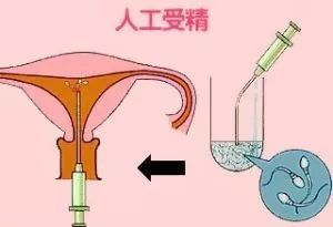 卵巢早衰