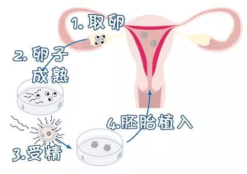 卵巢早衰