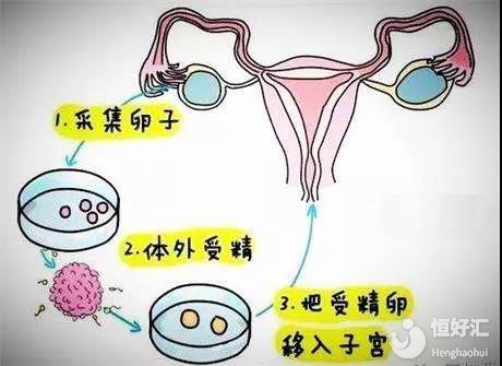 卵巢早衰